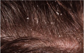 How to Get Rid of Dandruff on the Skin and Beauty